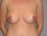 Patient # 97049 After Photo # 2